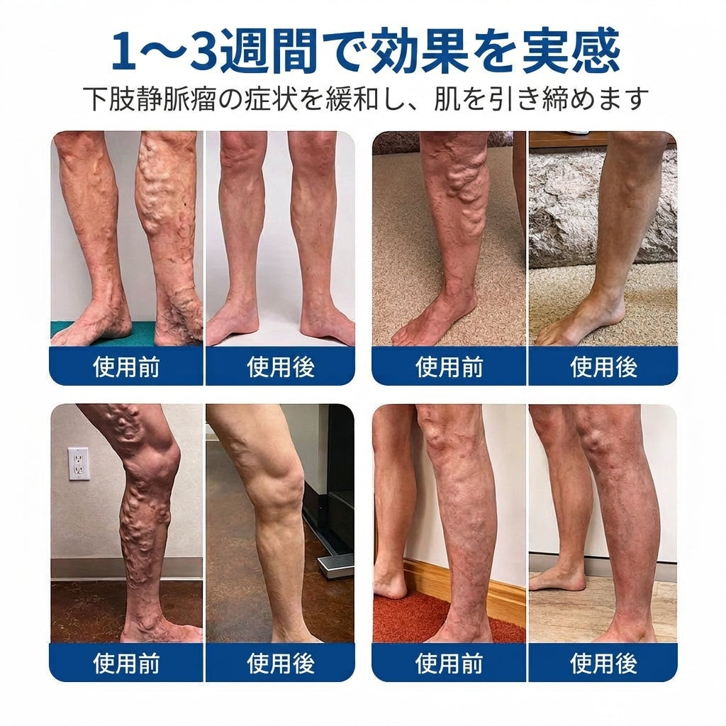 ✨🧑‍⚕️ FFBSI® 下肢静脈瘤ケア用マイクロニードルパッチ ⚡ すぐに実感できる快適さ、長期的な効果